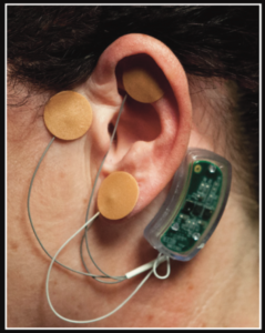The Bridge Opiate Withdrawal Treatment Device